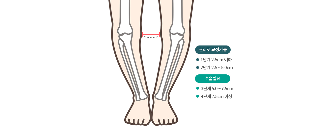 휜다리 자가진단