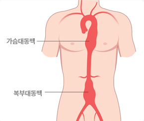 심혈관센터 흉복부대동맥류