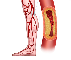 심혈관센터 말초동맥질환