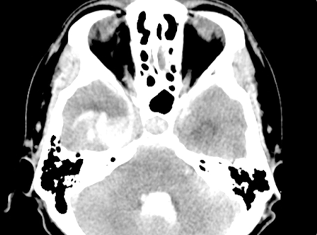 유착이 발생된 관절낭 MRI