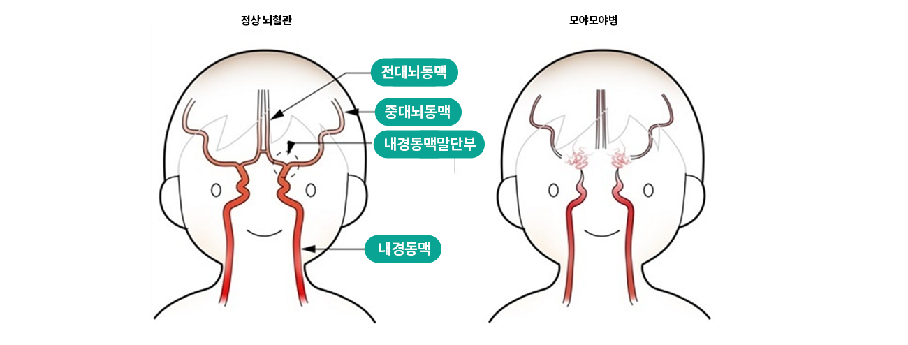 뇌혈관센터 경동맥협착