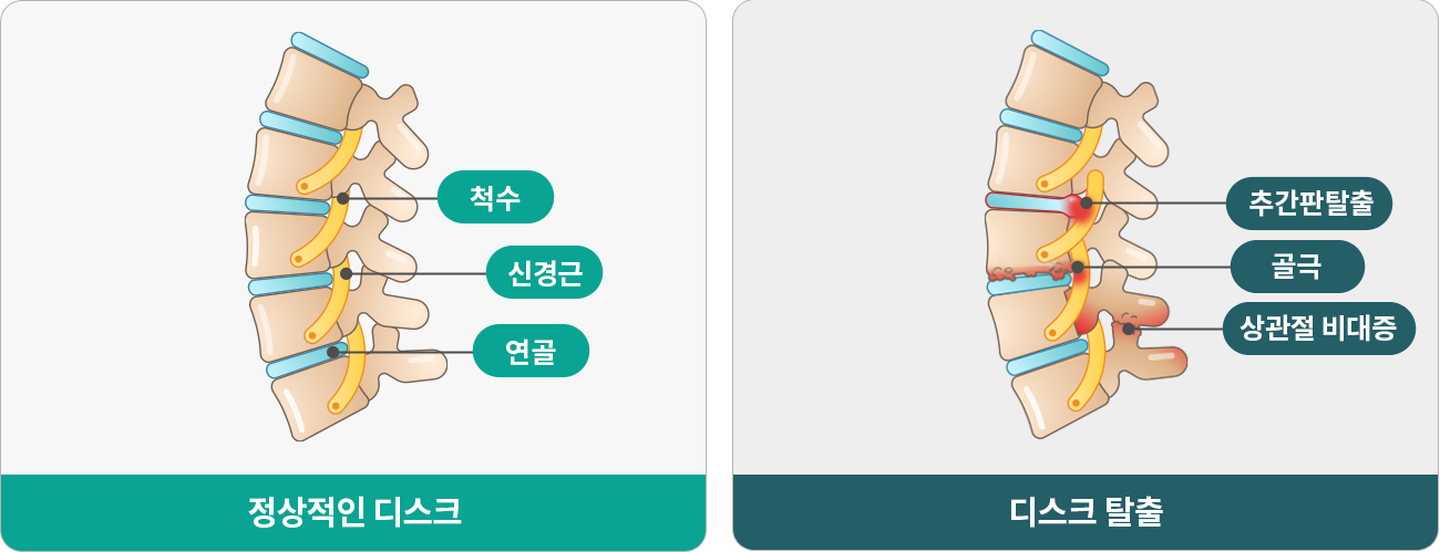 척추관협착증