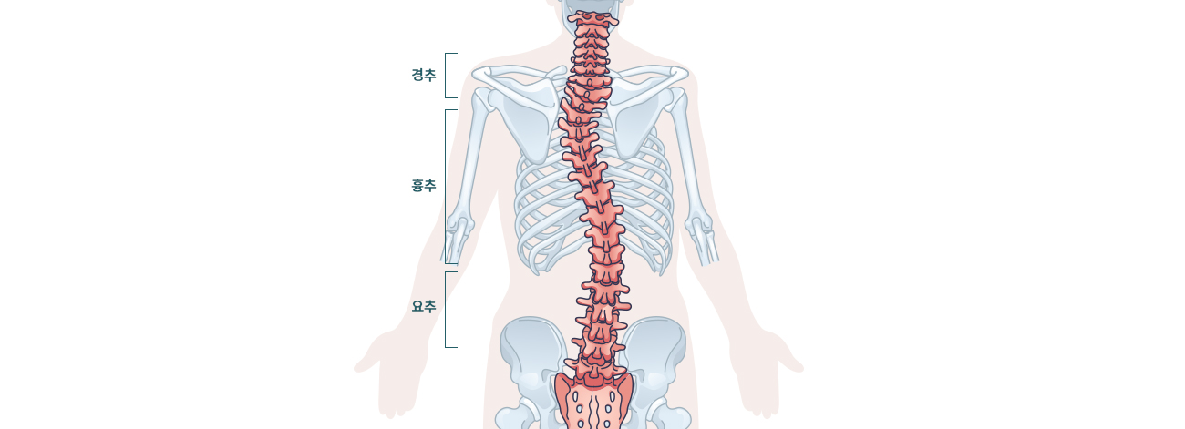 척추측만증