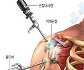 관절내시경술