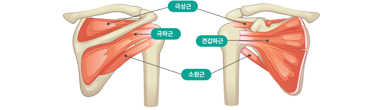 회전근개파열