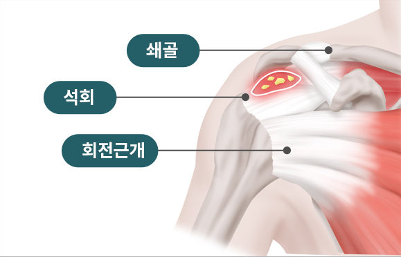 석회성건염