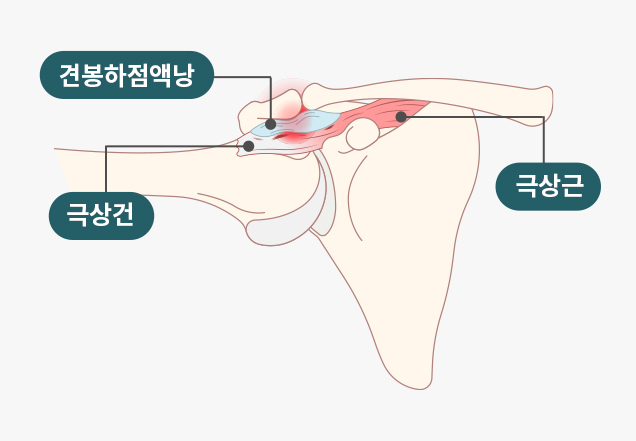 어깨충돌증후군