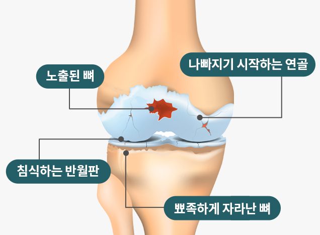 퇴행성관절염