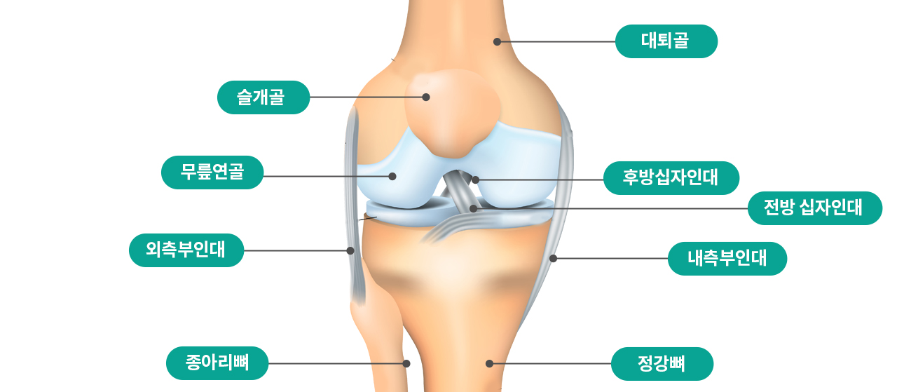 십자인대파열