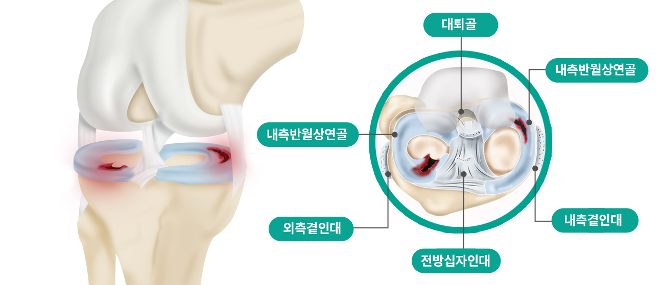 반월상연골판파열