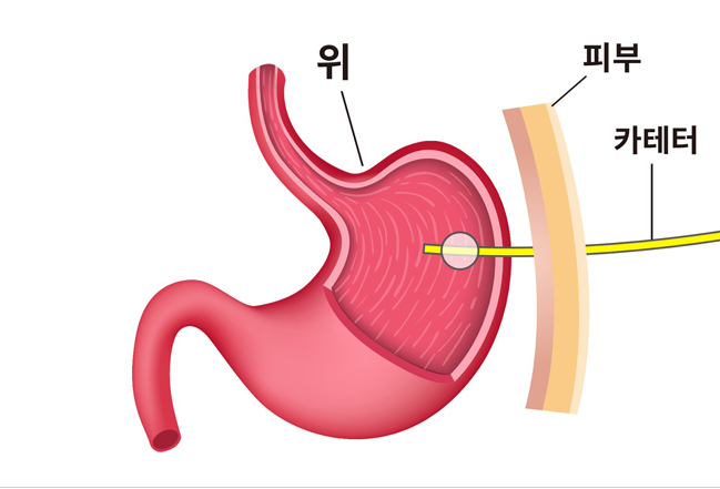 위루 설치술