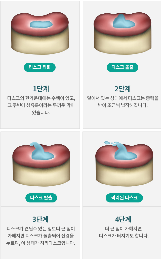 허리디스크