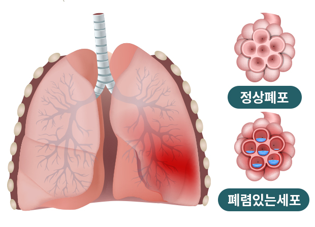 폐렴