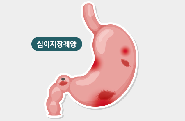 기관코일색전술