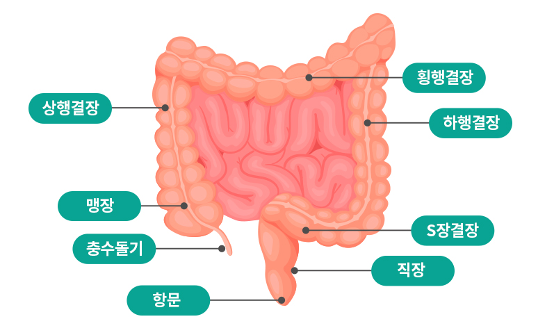 충수염 (맹장염)