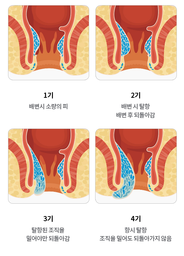 십자인대파열